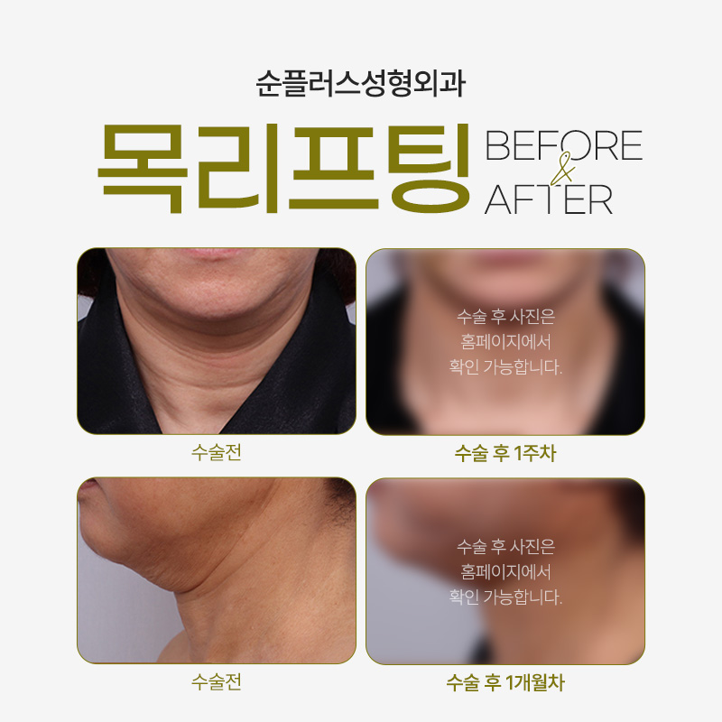 Neck Lift Depending on Horizontal and Vertical Neck Wrinkles image 6