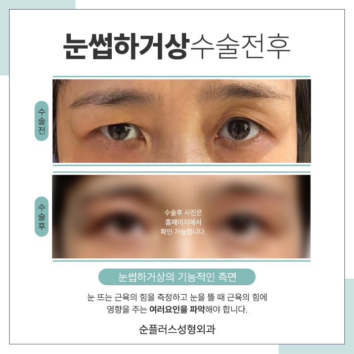 눈썹거상수술 자연스러움을 살리며 관련 이미지 6