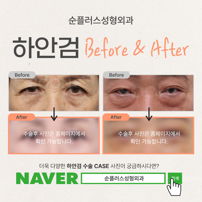 하안검수술회복기간 처짐에 따라 관련 이미지 5