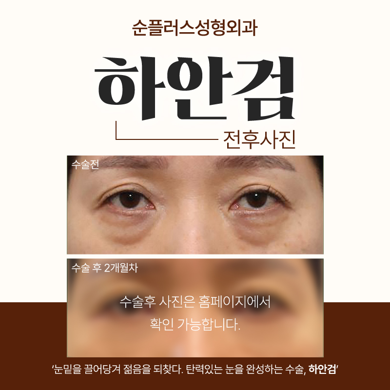 Gangnam under-eye blepharoplasty clinic: improving sagging skin and fat image 5