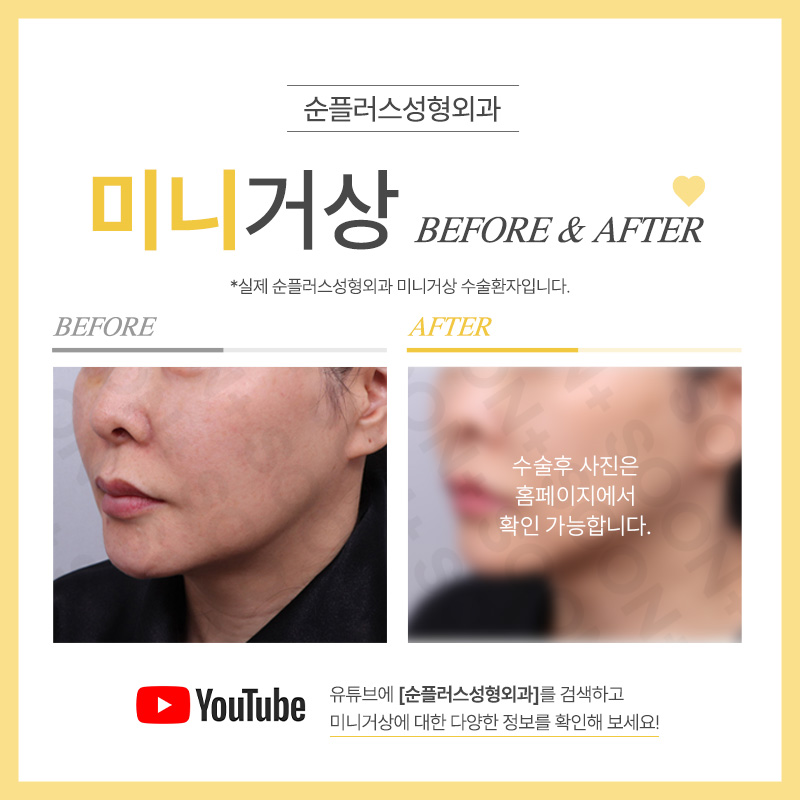 미니거상술 부분적 피부 처짐과 주름에 적합 관련 이미지 6