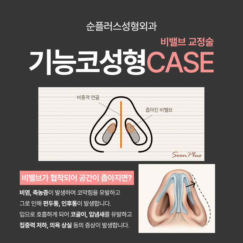 기능코수술 비염 등의 기능적 개선에 콧대 라인까지 관련 이미지 4