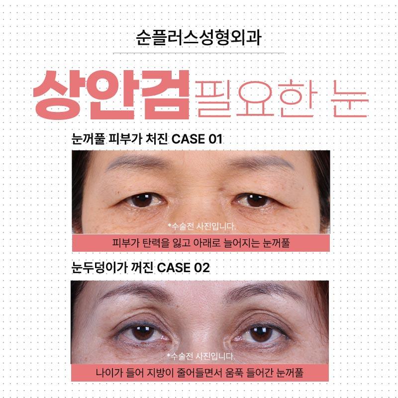 처진눈수술 자연스럽게 또렷해지는 눈매 관련 이미지 3