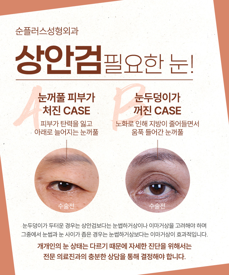 나이가 들어 생긴 눈꺼풀처짐이 고민이라면 중년눈성형, 상안검수술 고려해야 관련 이미지 3