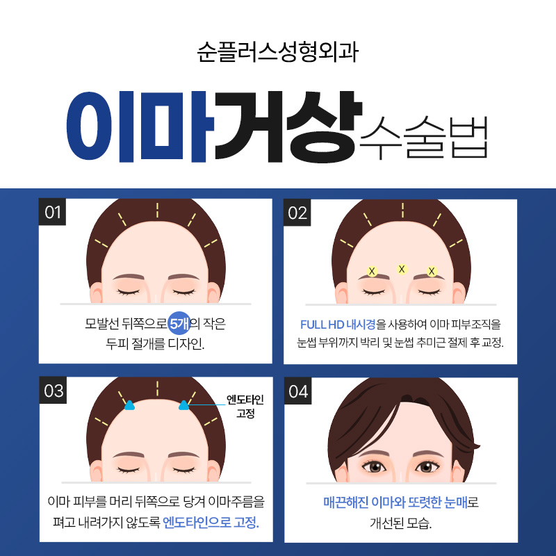 Differences in the Effect of Endoscopic Forehead Lift by Age image 6