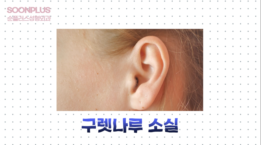 안면거상부작용 왜 나타날까? [칼귀/구렛나루 소실/피부괴사] 관련 이미지 3