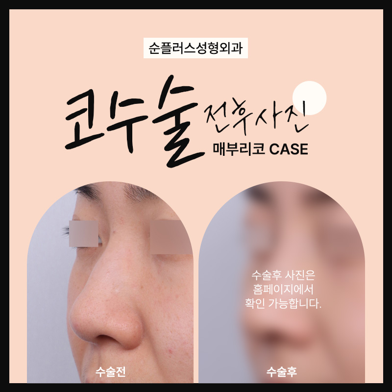 콧대,코끝 코성형수술을 통한 입체감 상승 관련 이미지 5