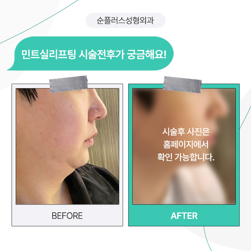 실리프팅잘하는곳 효과, 주의사항 까지 관련 이미지 6
