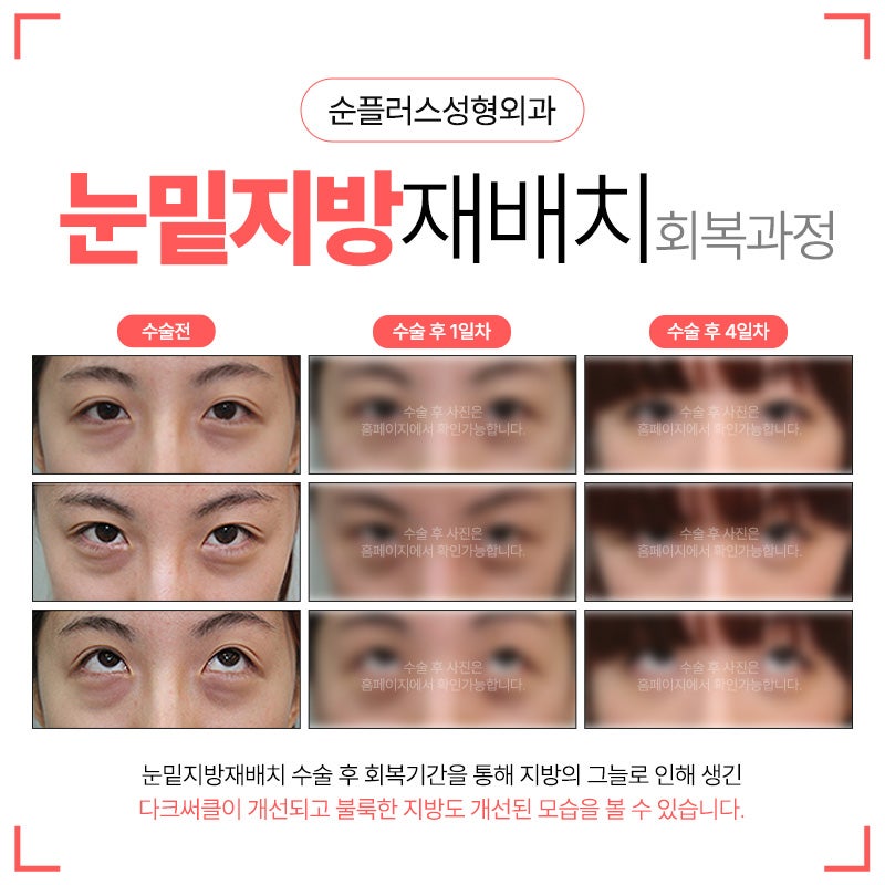 눈밑지방수술 적절한 제거 및 재배치로 눈밑 매끄럽게 관련 이미지 5