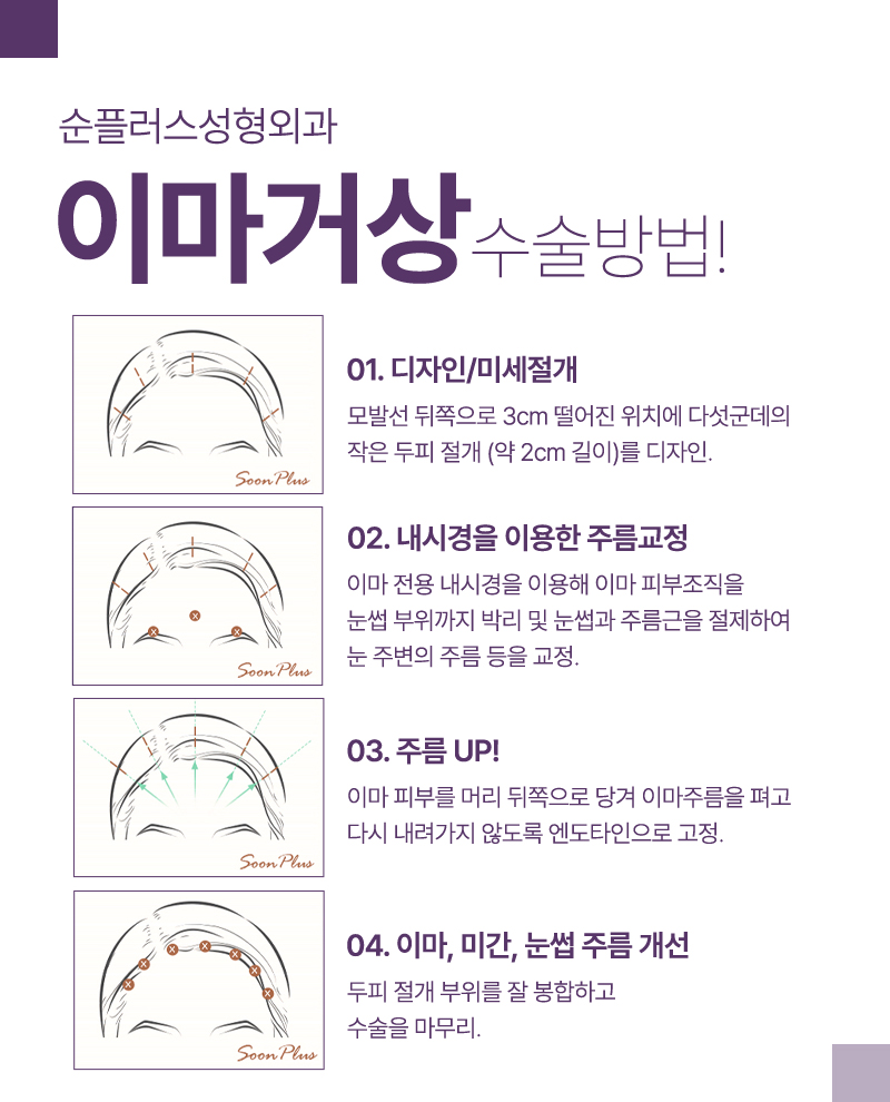 내시경 이마거상 피부 처짐에 따른 맞춤 솔루션 관련 이미지 3