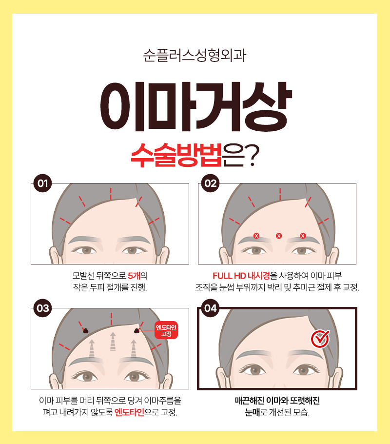 이마,눈매,인상 개선까지 이마거상술의 다양한 효과 관련 이미지 5