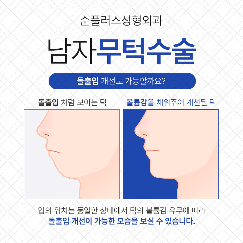 Balancing a Receding Chin to Enhance Attractiveness image 4