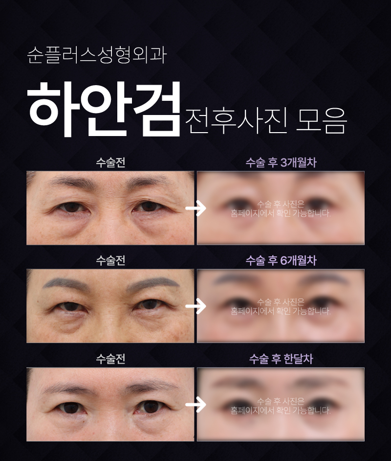 Appropriate Midlife Lower Eyelid Surgery with the Right Surgical Method image 3