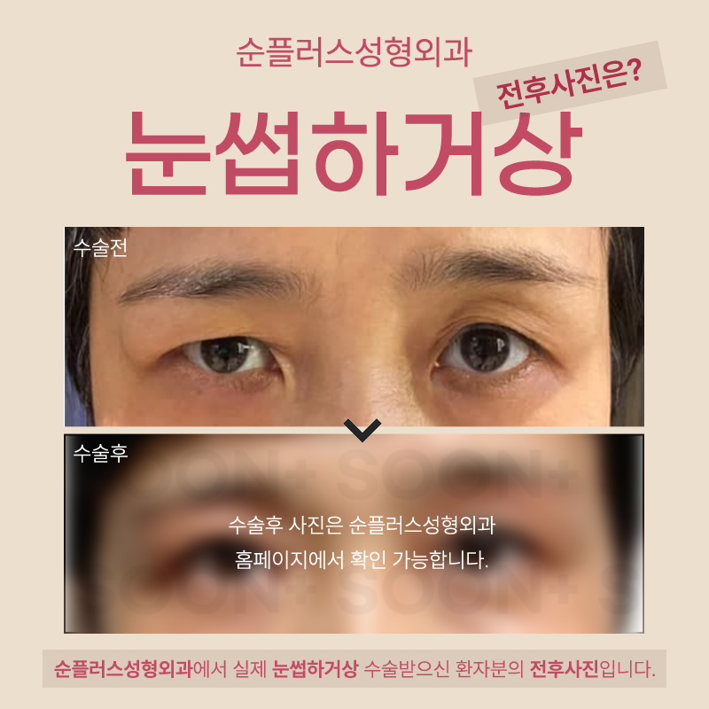 눈썹하거상 흉터 노출 줄이면서 눈은 또렷하게 관련 이미지 6