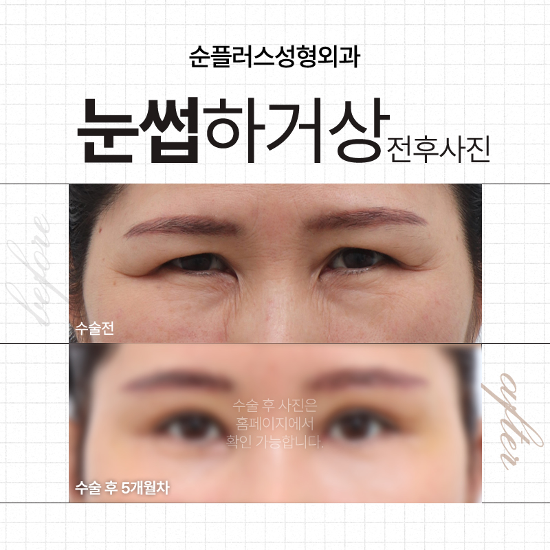 Making Parents’ Drooping Eyelids Look Clearer with the Effect of a Sub-Brow Lift image 6
