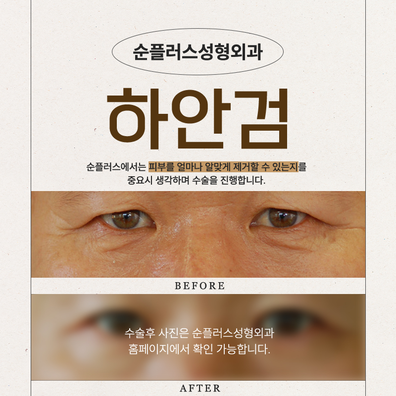 The Effects That Change Depending on the Difference in the Under-Eye Area with Lower Blepharoplasty image 5