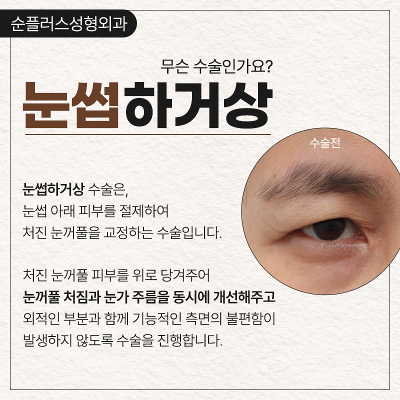 Brow Lift Surgery to Raise Sagging Eyelids and Improve the Eye Shape image 2