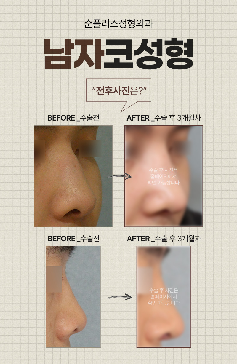 남자코성형잘하는곳 비율과 균형을 맞춰 입체감 살리고 관련 이미지 3