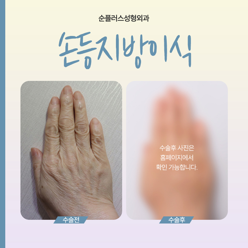 Hand Back Fat Grafting: The Traces of Time in Your Hands image 5