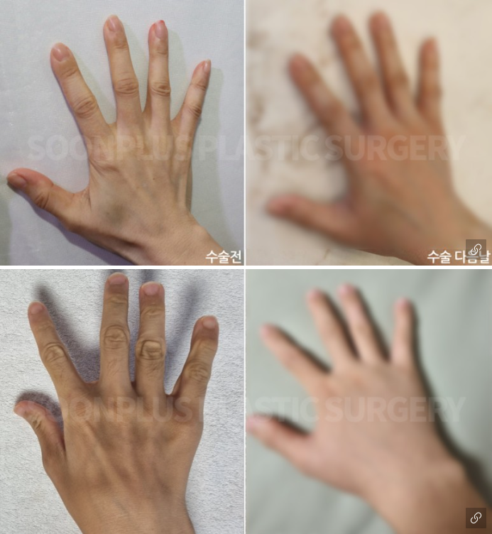 동안의 포인트는 손에서 나온다? [손등지방이식] 관련 이미지 5