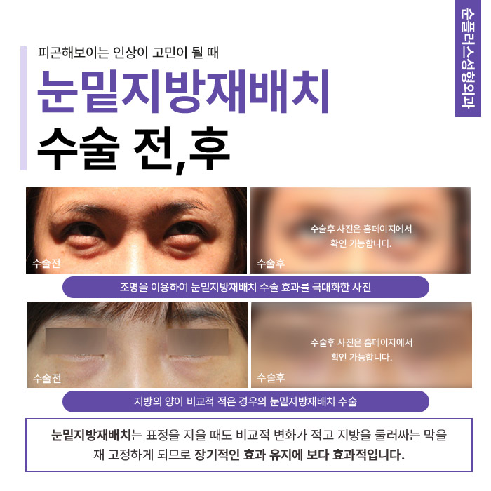 Improving Bumpy Under-Eye Contours Caused by Hollowing and Fat Bulging Through Under-Eye Fat Surgery image 4