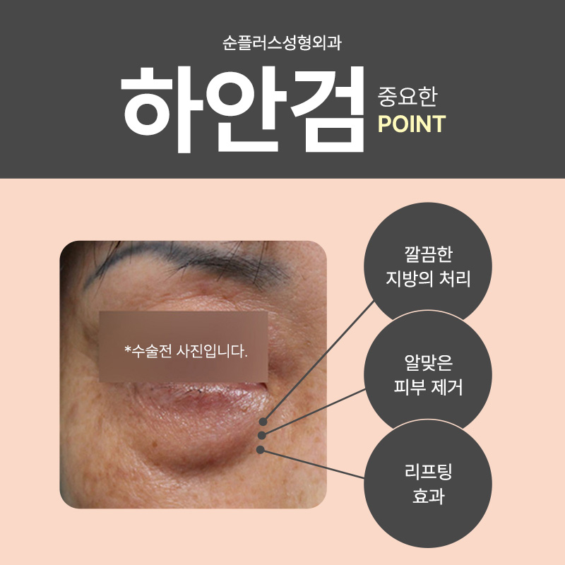 하안검수술비용 주름 지방 동시에 개선을 관련 이미지 3