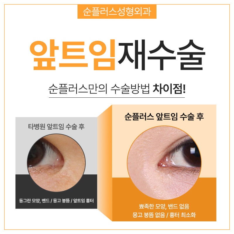 앞트임재수술 복원으로 눈앞머리 자연스럽게 관련 이미지 4