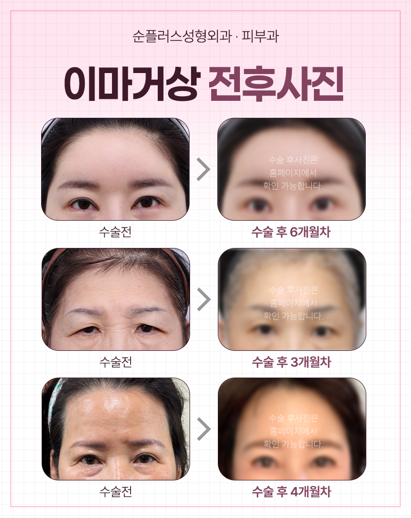처진 눈매, 자연스럽게 시원해지는 방법 - 이마거상술 관련 이미지 4