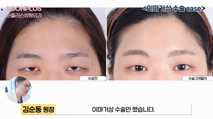 What Surgery Is Performed to Improve Drooping Eyelids and Sagging Eyes, Even by Celebrities? image 6