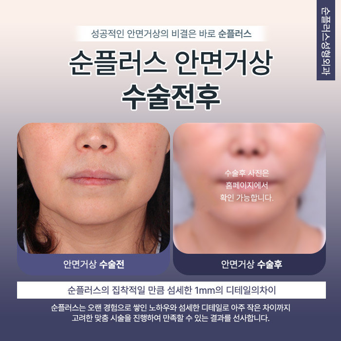 스마스리프팅 피부노화 개선을 위하여 관련 이미지 6