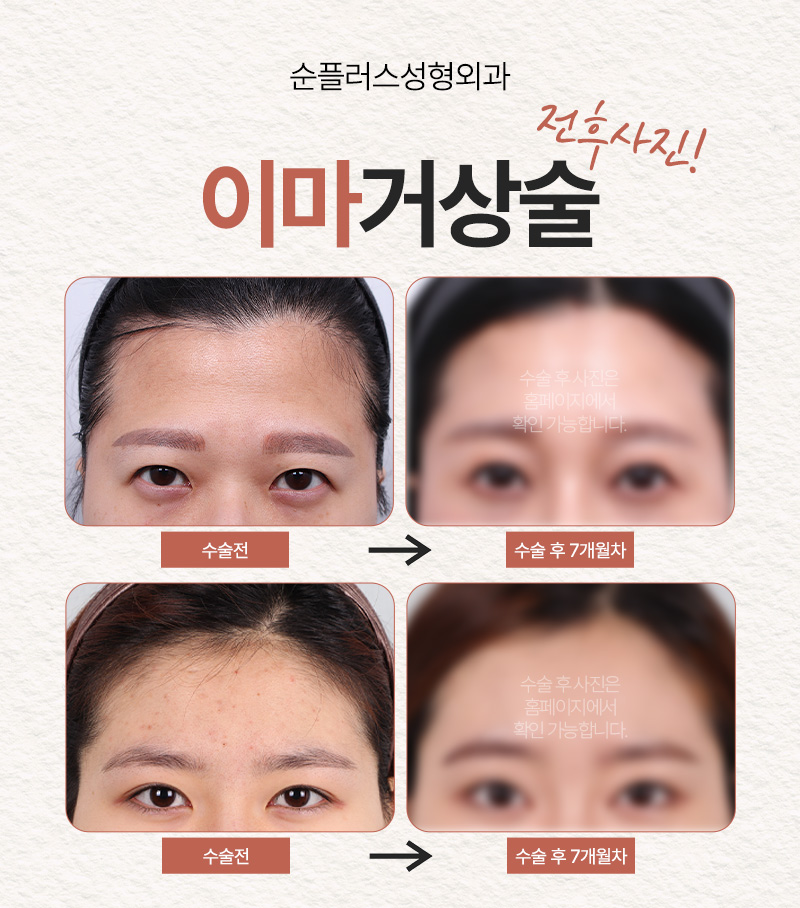 For Improving Endotine Brow Lift Fixation and Durability image 3