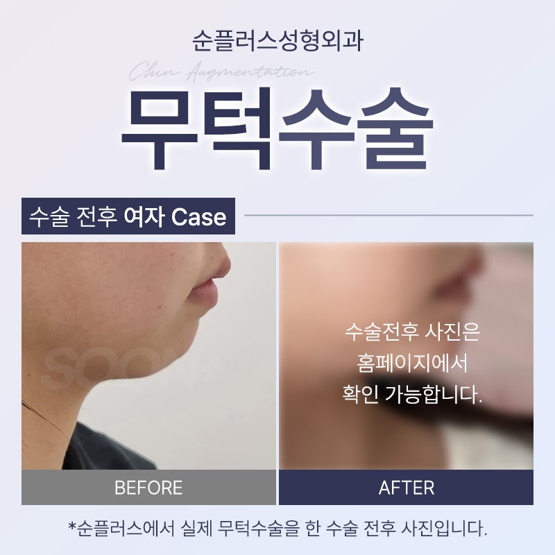 무턱수술 하악에 볼륨을 주어 관련 이미지 4