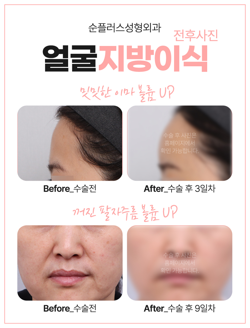 얼굴지방이식잘하는곳 볼륨이 필요한 곳에 관련 이미지 6