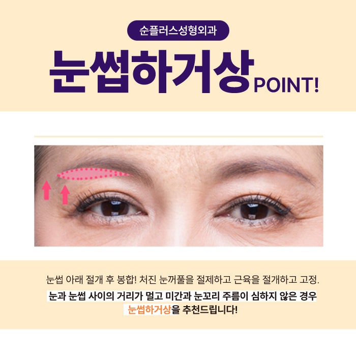 눈꺼풀처짐수술, 눈썹하거상 케이스로는 관련 이미지 5