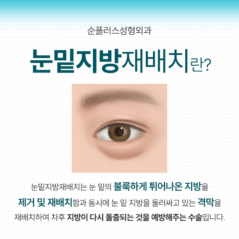 눈밑지방재배치 재수술 예방 위해 격막강화, 이중고정으로 관련 이미지 2