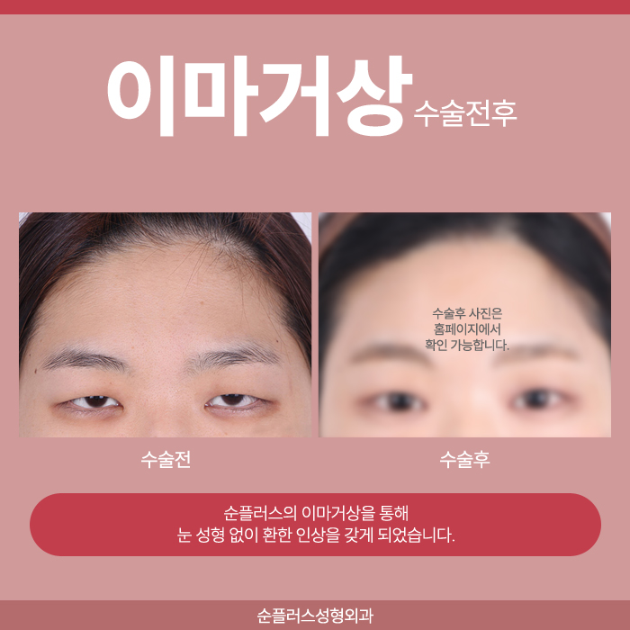 이마주름수술 자연스러운 개선방안을 위해 관련 이미지 5