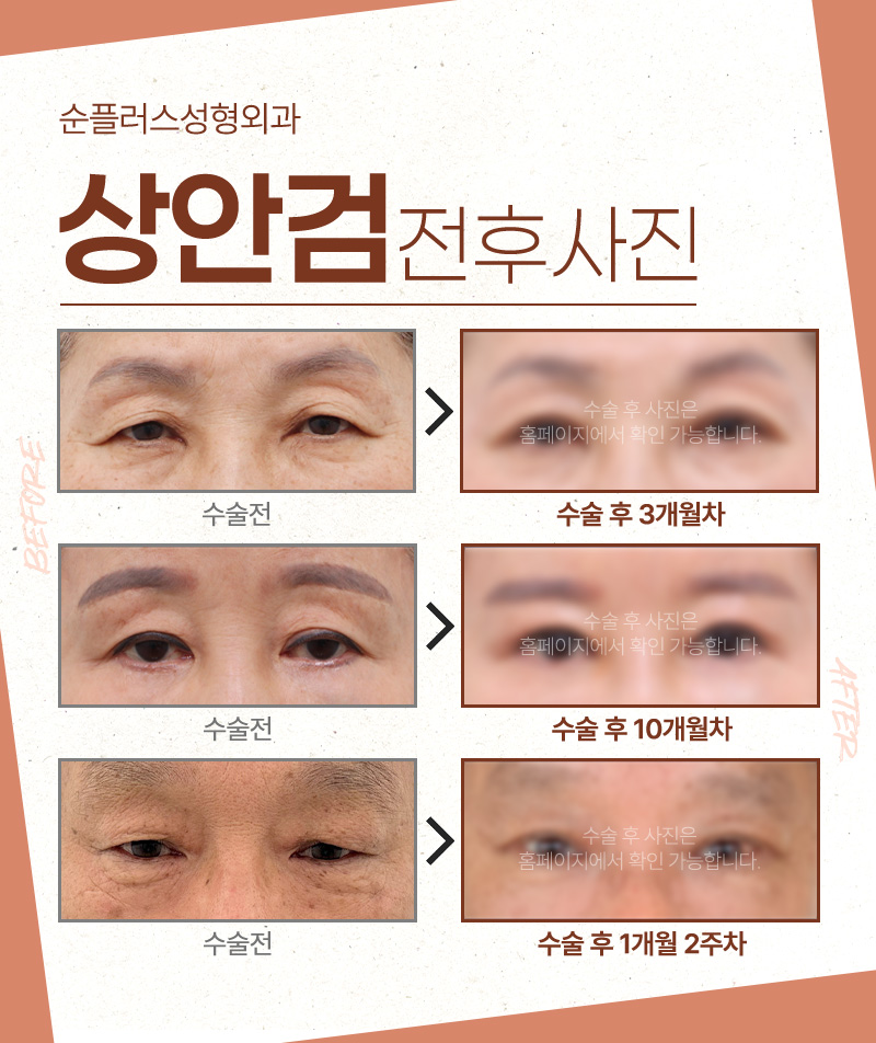 나이가 들어 생긴 눈꺼풀처짐이 고민이라면 중년눈성형, 상안검수술 고려해야 관련 이미지 5