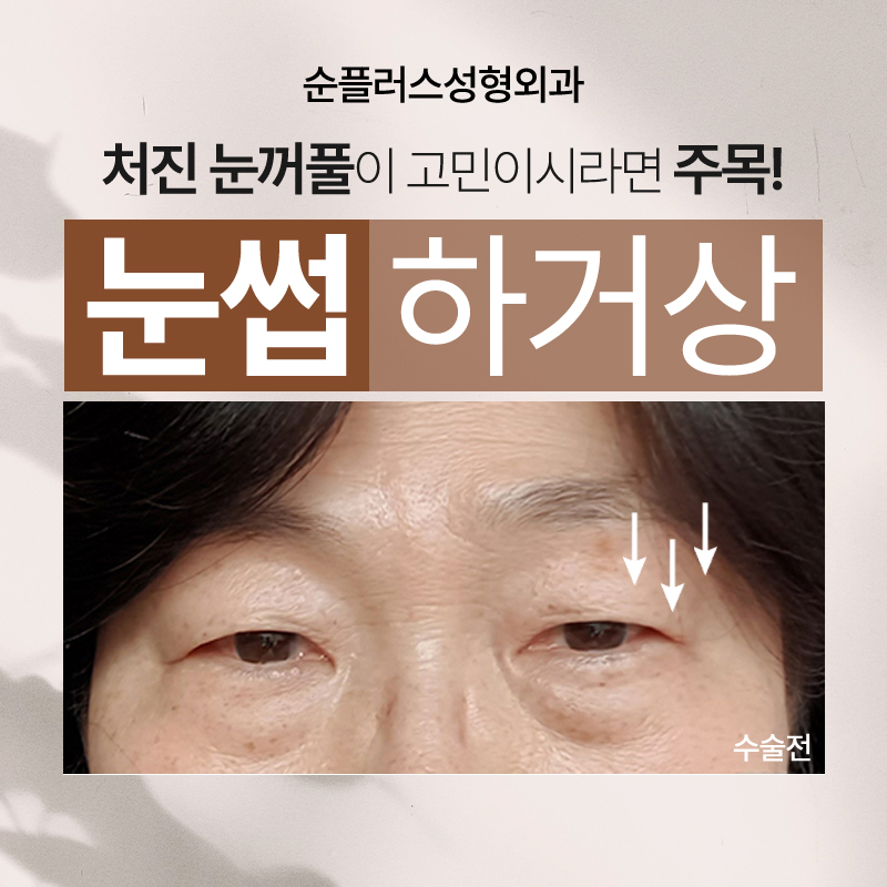 Making Parents’ Drooping Eyelids Look Clearer with the Effect of a Sub-Brow Lift image 1