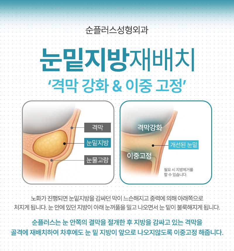 눈밑지방재배치 수술후 차후에도 지방이 돌출되지 않도록 이중고 관련 이미지 5