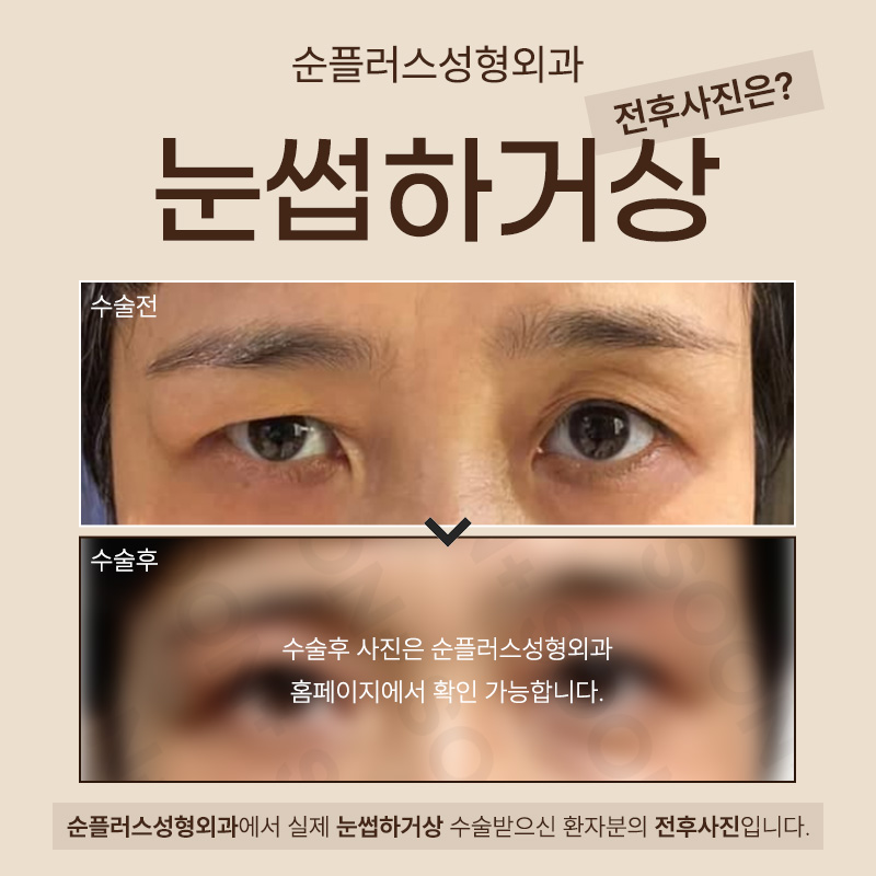 처진눈 자연스럽게 개선하기 위해 눈썹하거상 관련 이미지 6