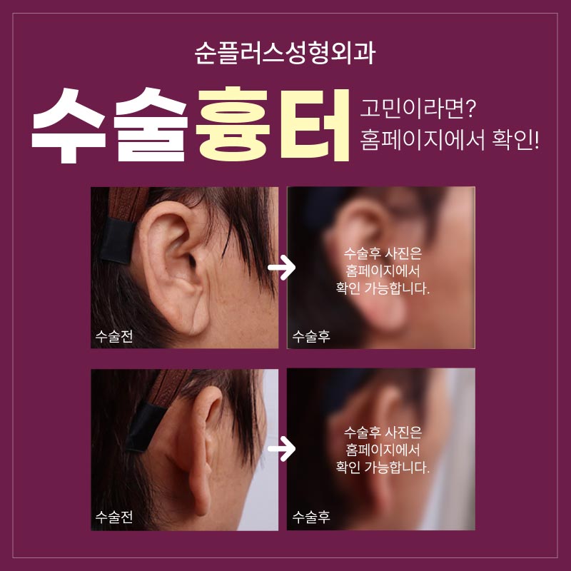 About the Effects of Facelift Surgery, Scarring, and Recovery Time image 6