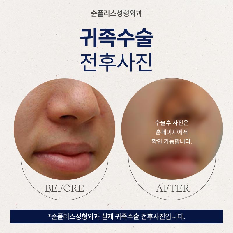 나이들어 보이는 팔자꺼짐, 개선방안은 관련 이미지 5