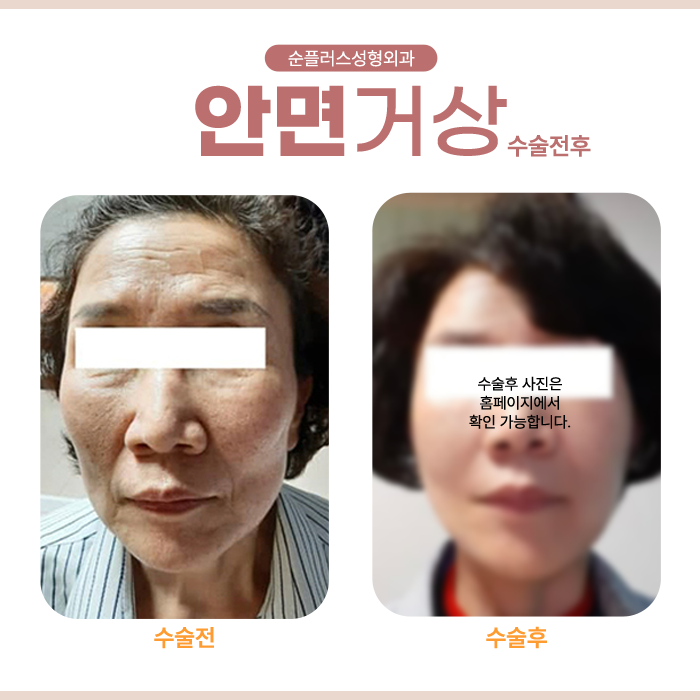 강남안면거상 피부가 광범위하게 처졌다면 관련 이미지 5
