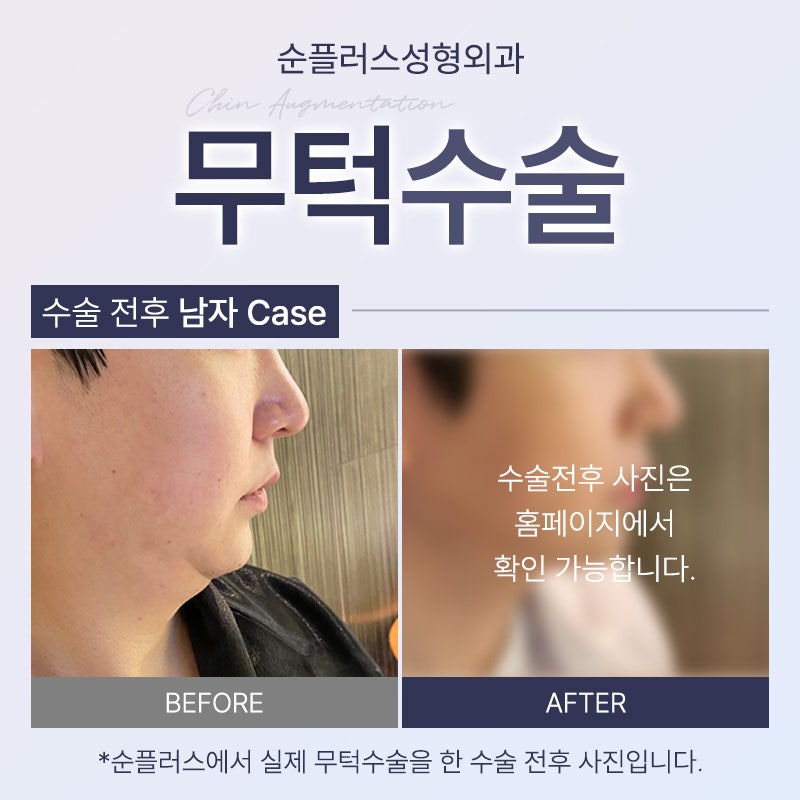 무턱수술 하악에 볼륨을 주어 관련 이미지 5