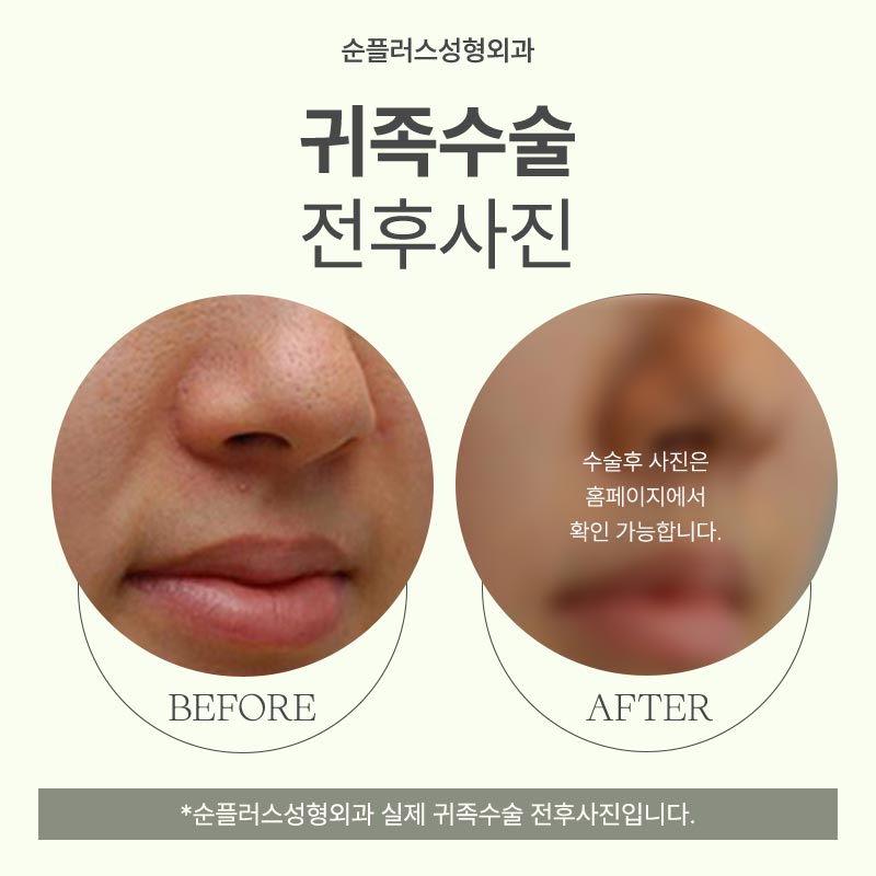 If a sunken area next to the nose makes the mouth look protruded and reduces facial depth image 5