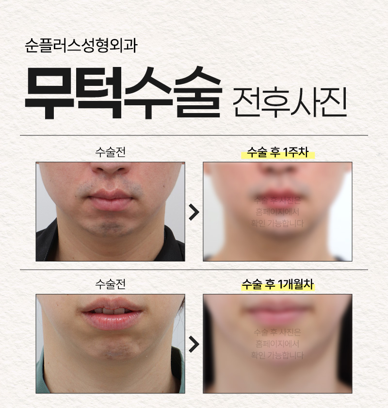 If you are considering chin surgery for a small, short recessed chin, achieve balance and proportions with a customized implant image 6
