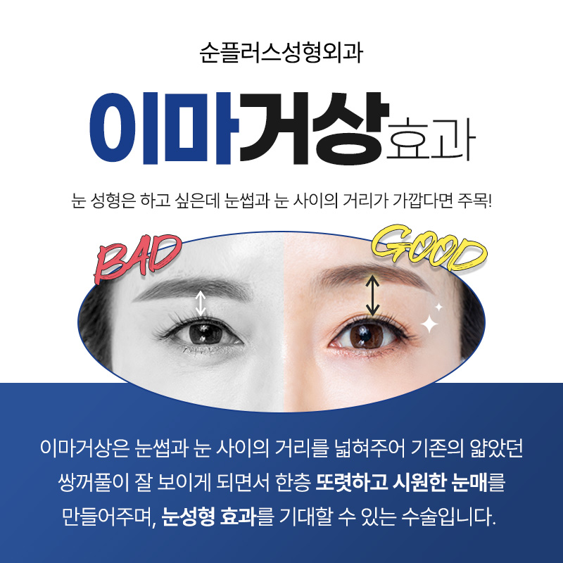 Differences in the Effect of Endoscopic Forehead Lift by Age image 4
