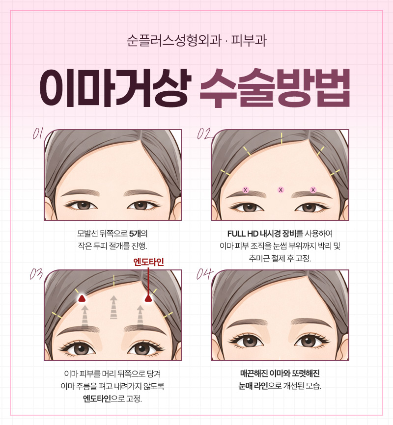 처진 눈매, 자연스럽게 시원해지는 방법 - 이마거상술 관련 이미지 3