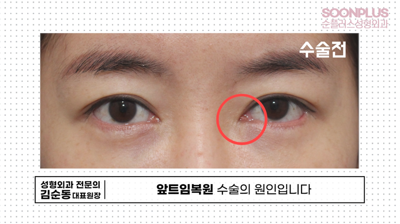 'Am I Really a Candidate for Epicanthoplasty Revision?' Dr. Kim Soondong’s Story About Epicanthoplasty Revision Surgery image 2