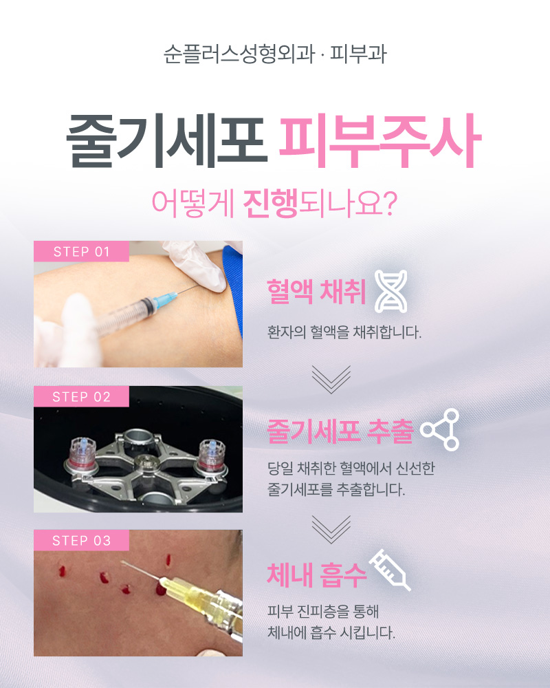 줄기세포피부주사, 어떤 효과들이 있고 유지기간은 얼마나? 관련 이미지 6